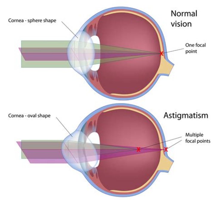 Are contacts for astigmatism more expensive?