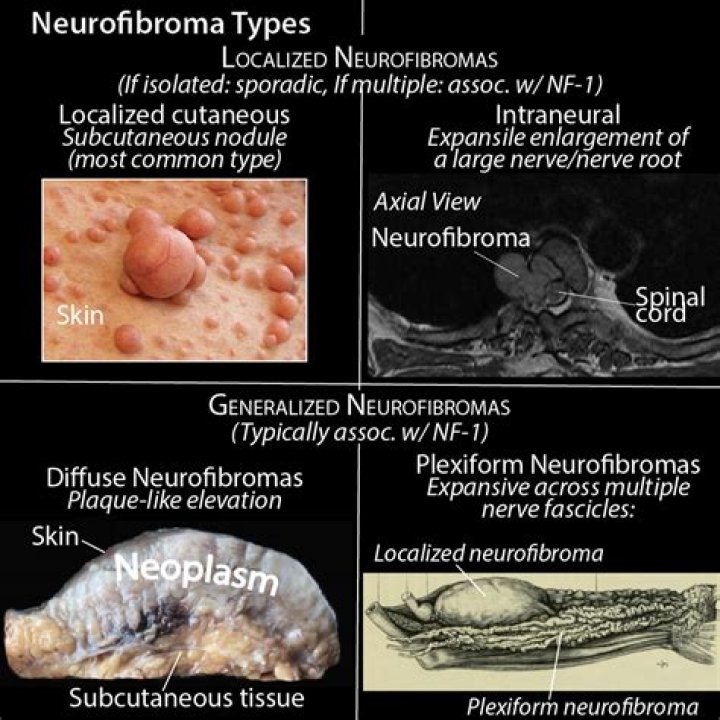 Are neurofibromas painful?
