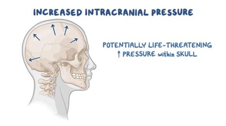 Can a CT scan show intracranial pressure?