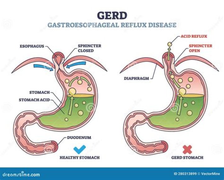 Can acid reflux cause gastroparesis?