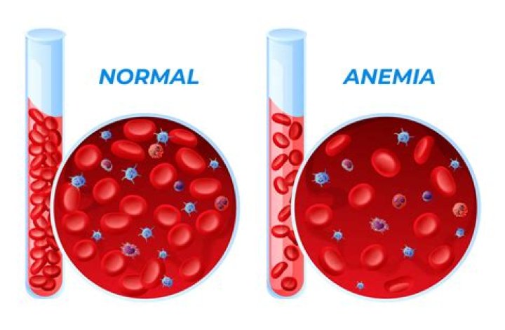 Can anemia make you thirsty?
