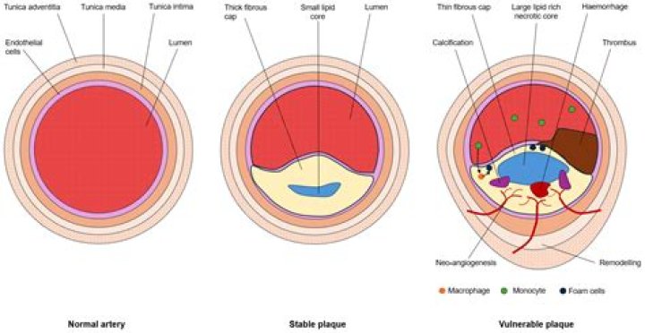 Can arterial plaque go away?