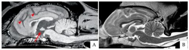 Can brain bleed heal itself?