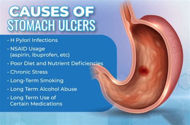 Can fluoride cause ulcers?