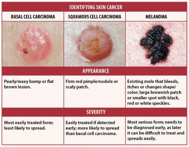 Can melanoma make you feel unwell?