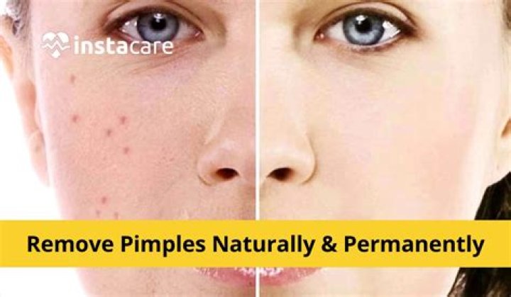 Can neem remove pimples?