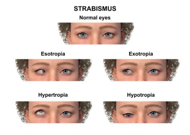 Can strabismus affect driving?