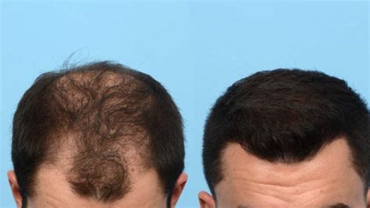Can you reverse balding?