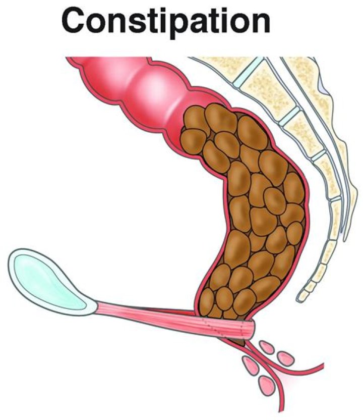 Can your intestines burst from constipation?