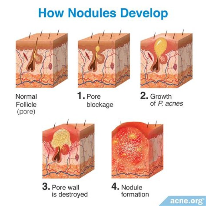 Do nodules go away?