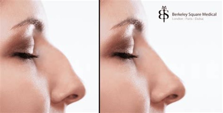 Do noses get thinner as we age?