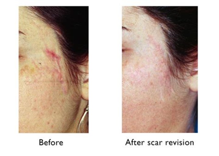 Do scars Ever Go Away?
