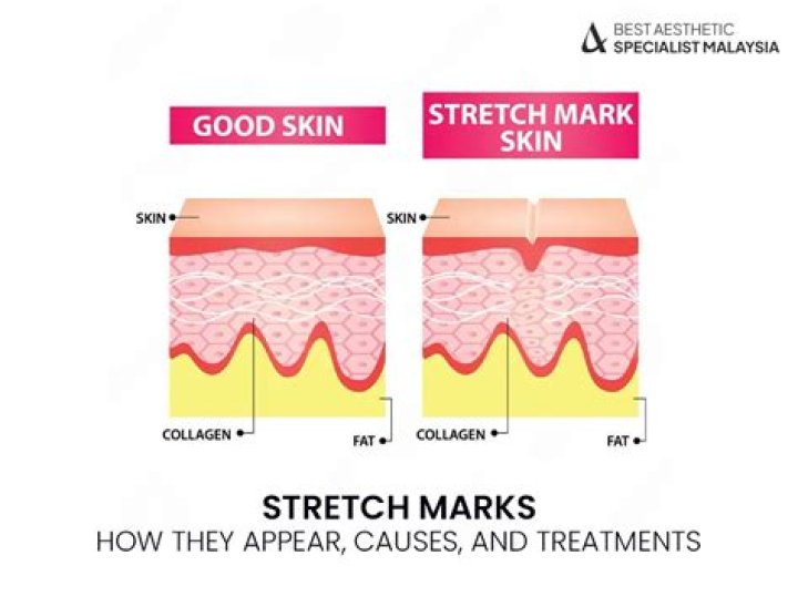 Do stretch marks ever completely fade?