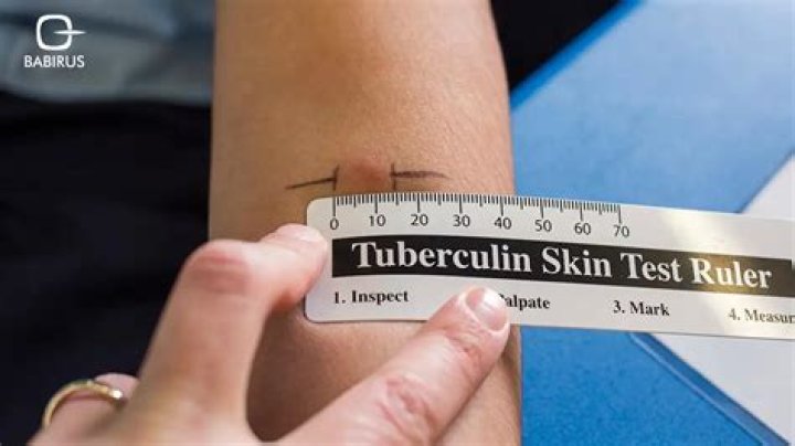 Do TB tests hurt?