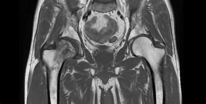 Does avascular necrosis show on MRI?