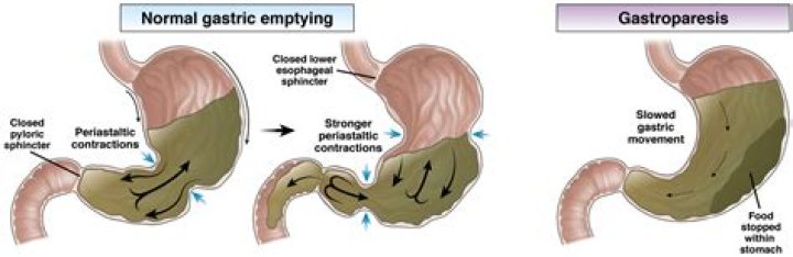 Does gastroparesis show up in blood work?