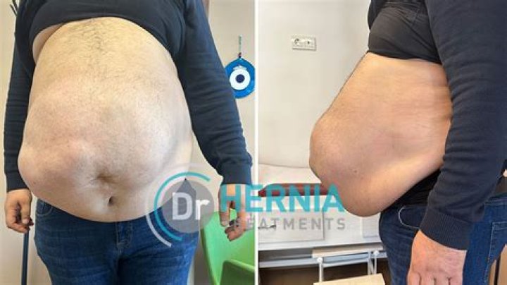 Does losing weight help hernia?