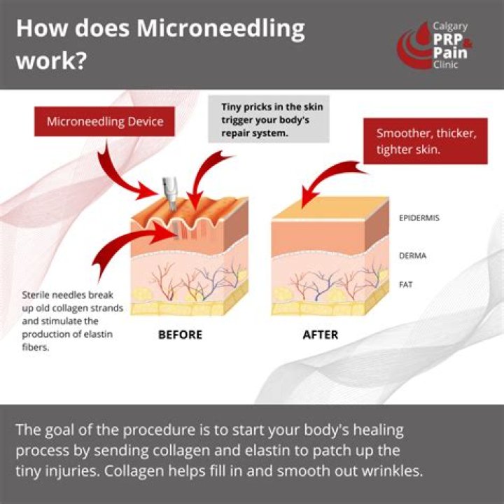 Does microneedling cause Crepey skin?