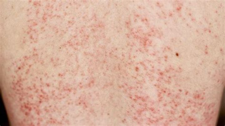 Does sepsis get worse before it gets better?