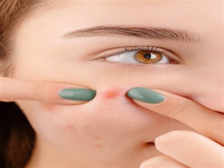Does steaming help blind pimples?