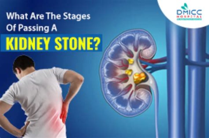 How can I force a kidney stone to pass at home?