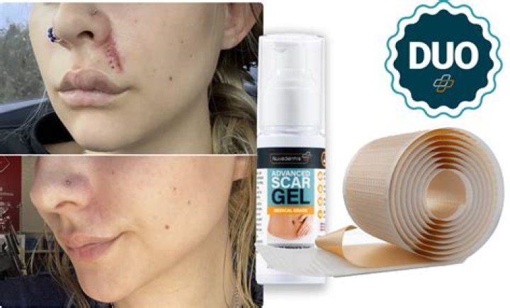 How can I make my scars lighter?