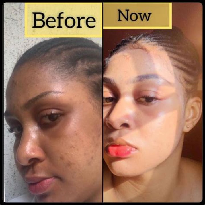 How can you tell if someone is bleaching their skin?