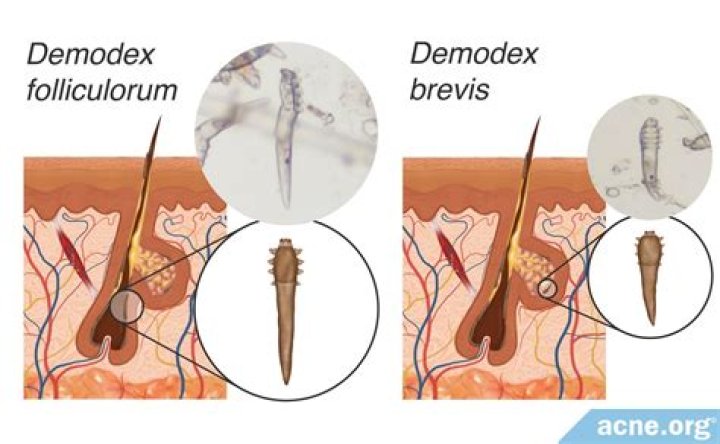 How do I get rid of Demodex mites on my skin?