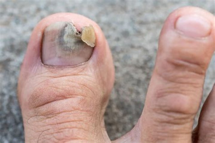 How do I get rid of the thickness under my toenails?