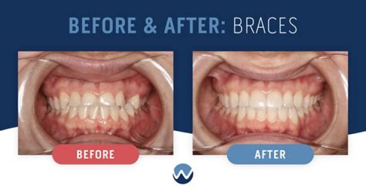 How do I know if I'm almost done with braces?