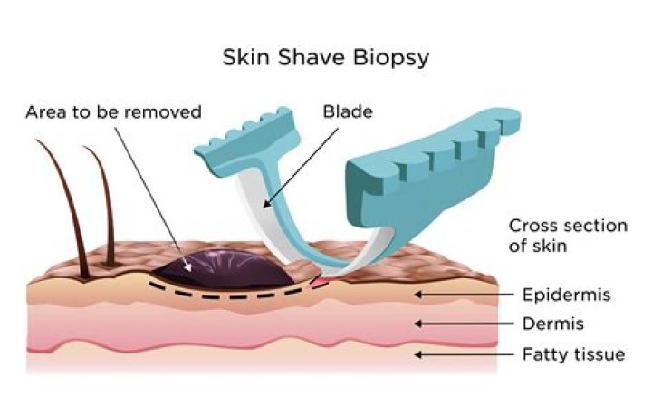 How long do you stay in hospital after a biopsy?