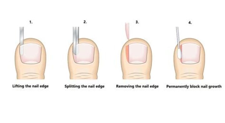 How long does it take for an ingrown toenail to grow out?