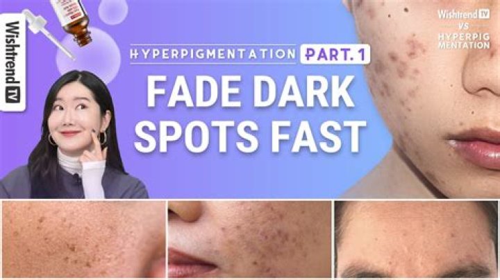 How long does it take hyperpigmentation to fade?