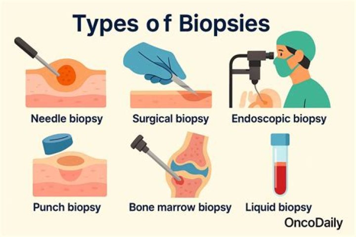 How long does it take to get the results of a biopsy?