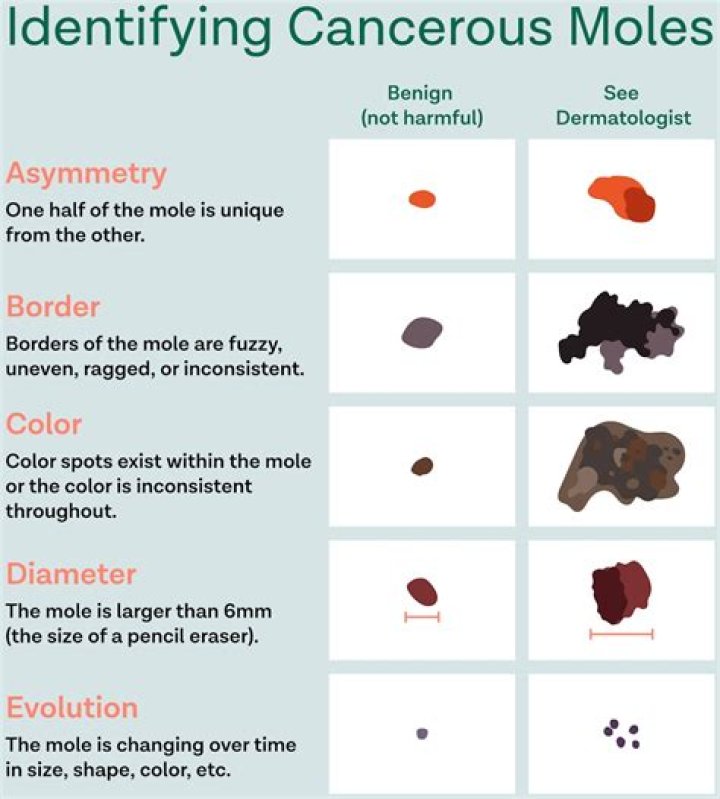 How often do moles become cancerous?