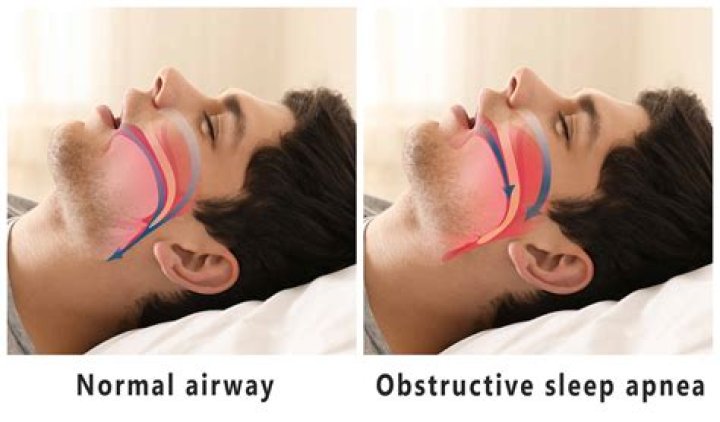 How serious is sleep apnea?
