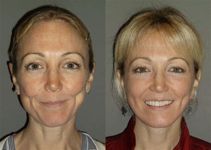 Is 40 too old for plastic surgery?