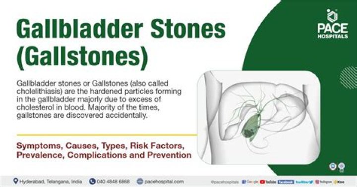 Is a 5 cm gallstone big?