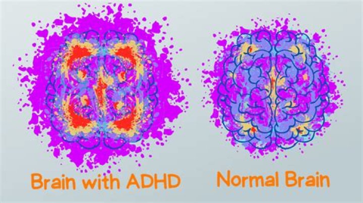 Is ADHD real?
