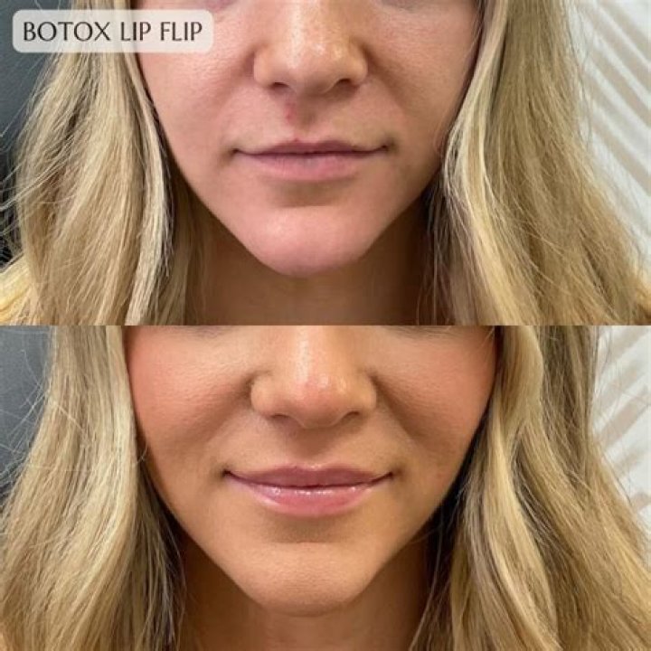 Is Botox or Dysport better for lip flip?