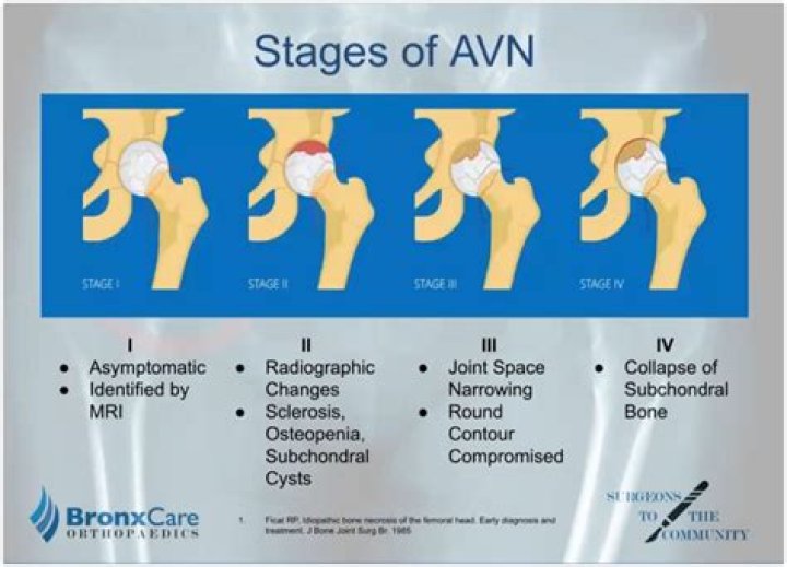 Is it mandatory to have surgery if you have avascular necrosis?