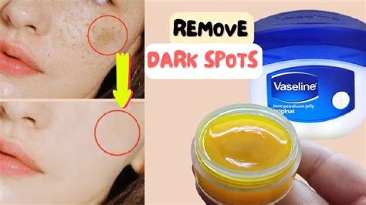 Is Vaseline good for your face acne?