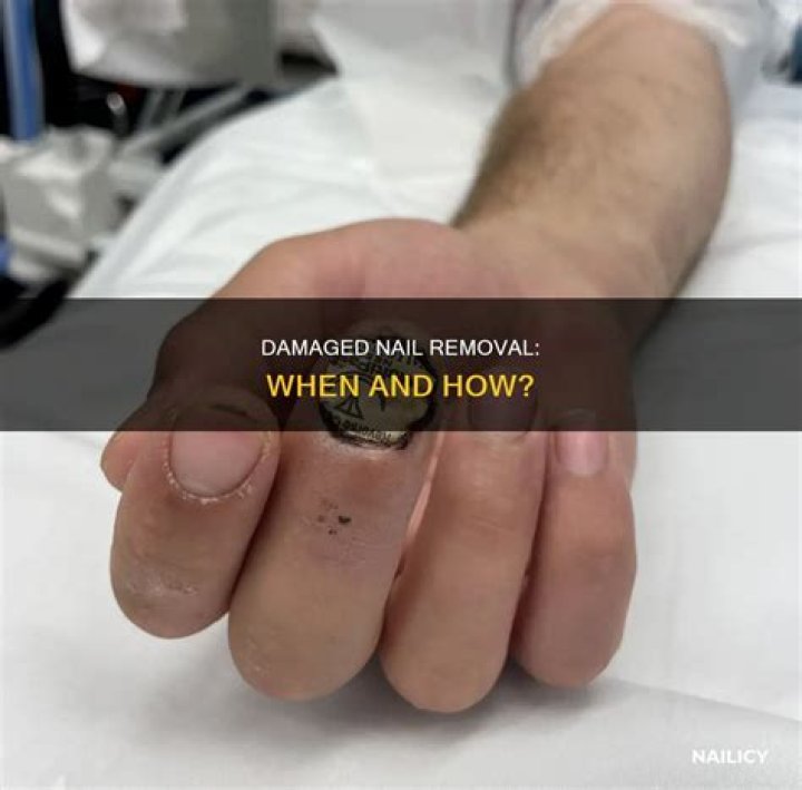 Should I remove a damaged nail?