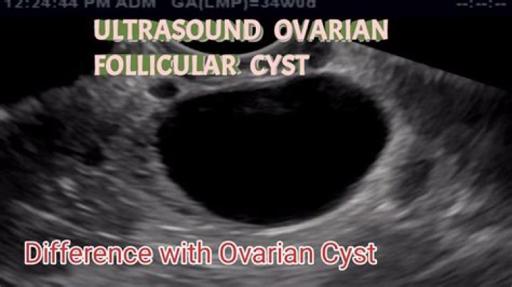 What are the odds of an ovarian cyst being cancerous?