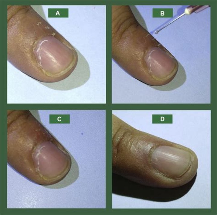 What causes a hangnail?