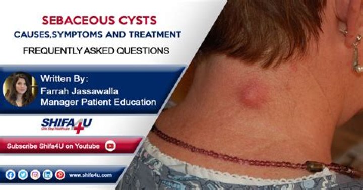 What causes Pilar cysts?