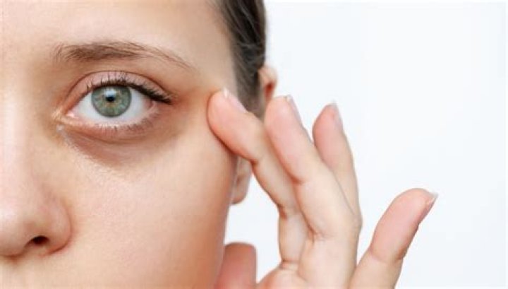 What causes raccoon eyes?