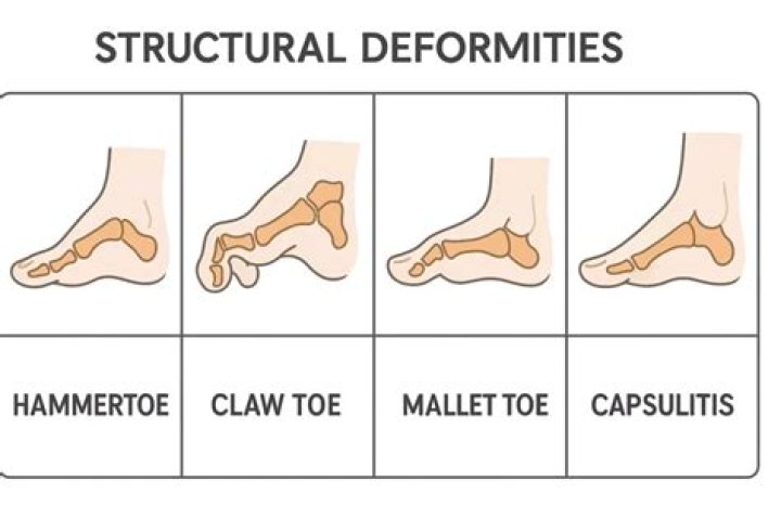 What causes toes to bend sideways?
