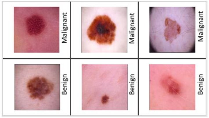 What do dermatologists look for in moles?