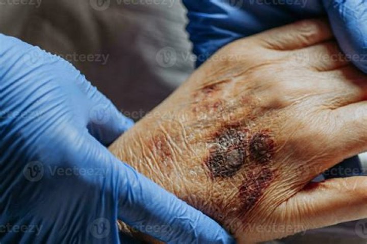 What do skin tears look like?